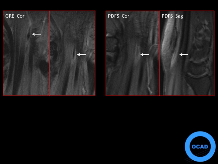 Figure 2 for case thrombus ( RID5037 )